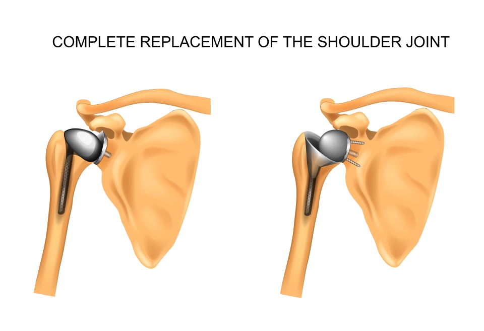 解剖和反向肩更换